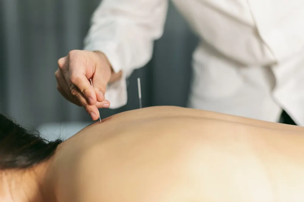 Acupuncture